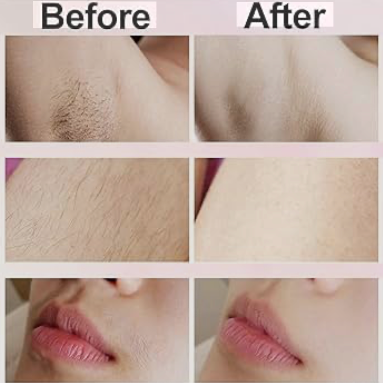 Before and after comparison of skin treatment on a person's neck and lips.